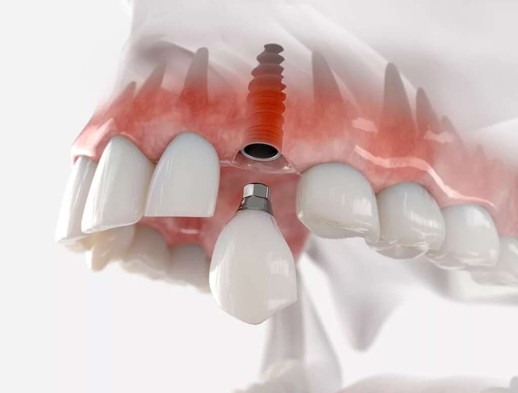 implante dental